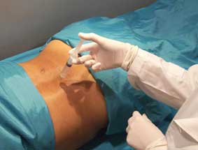 Aplican ozonoterapia en Hospital de Morón
